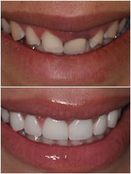 Before and after Dental Veneers