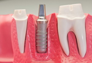 picture of dental implant