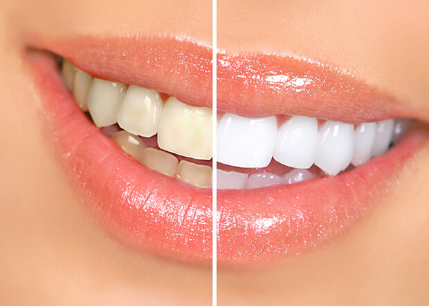 Before and after Dental Veneers